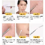 Alat Pencet Mengeluarkan Jerawat Dan Komedo Acne Removal 4pcs — 6